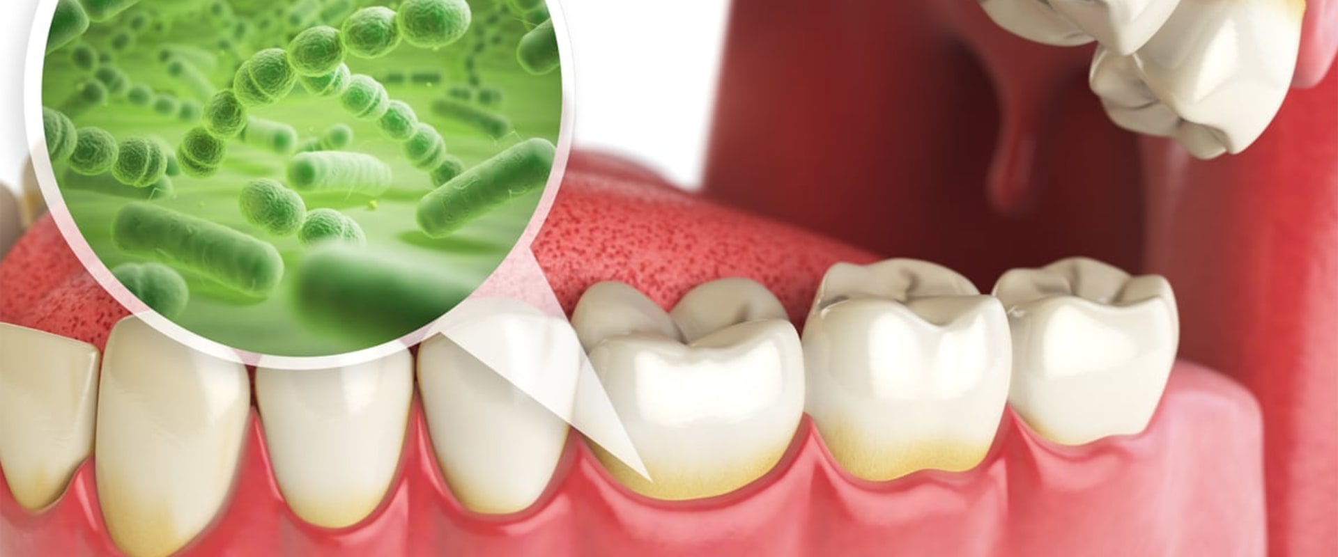 What is the cause of most oral disease?